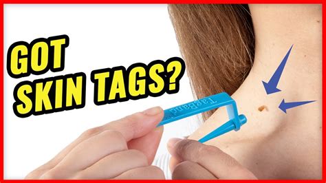 how to remove skin tags